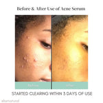 Acne Serum (Acne Out)